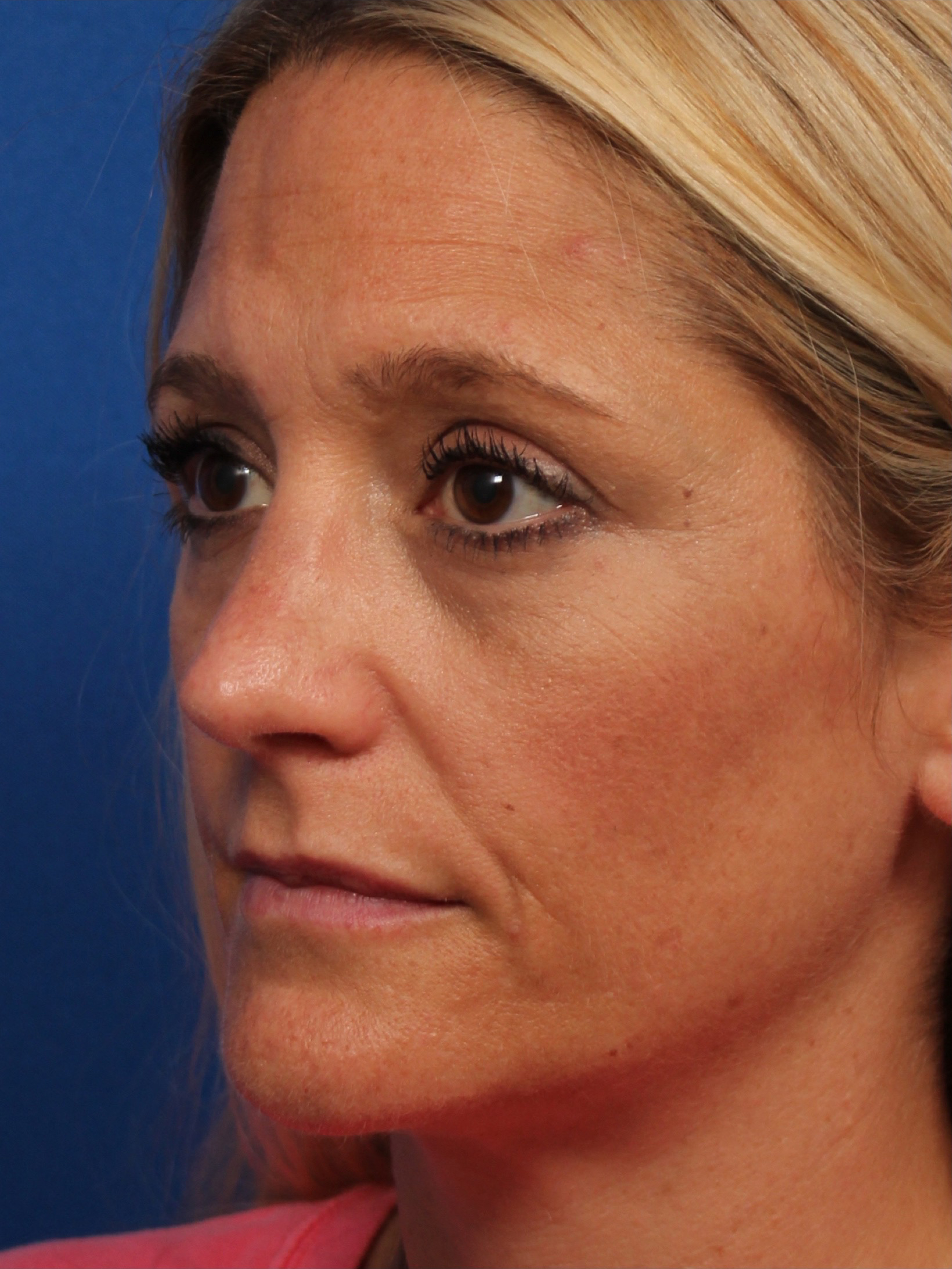 Female Cosmetic Rhinoplasty