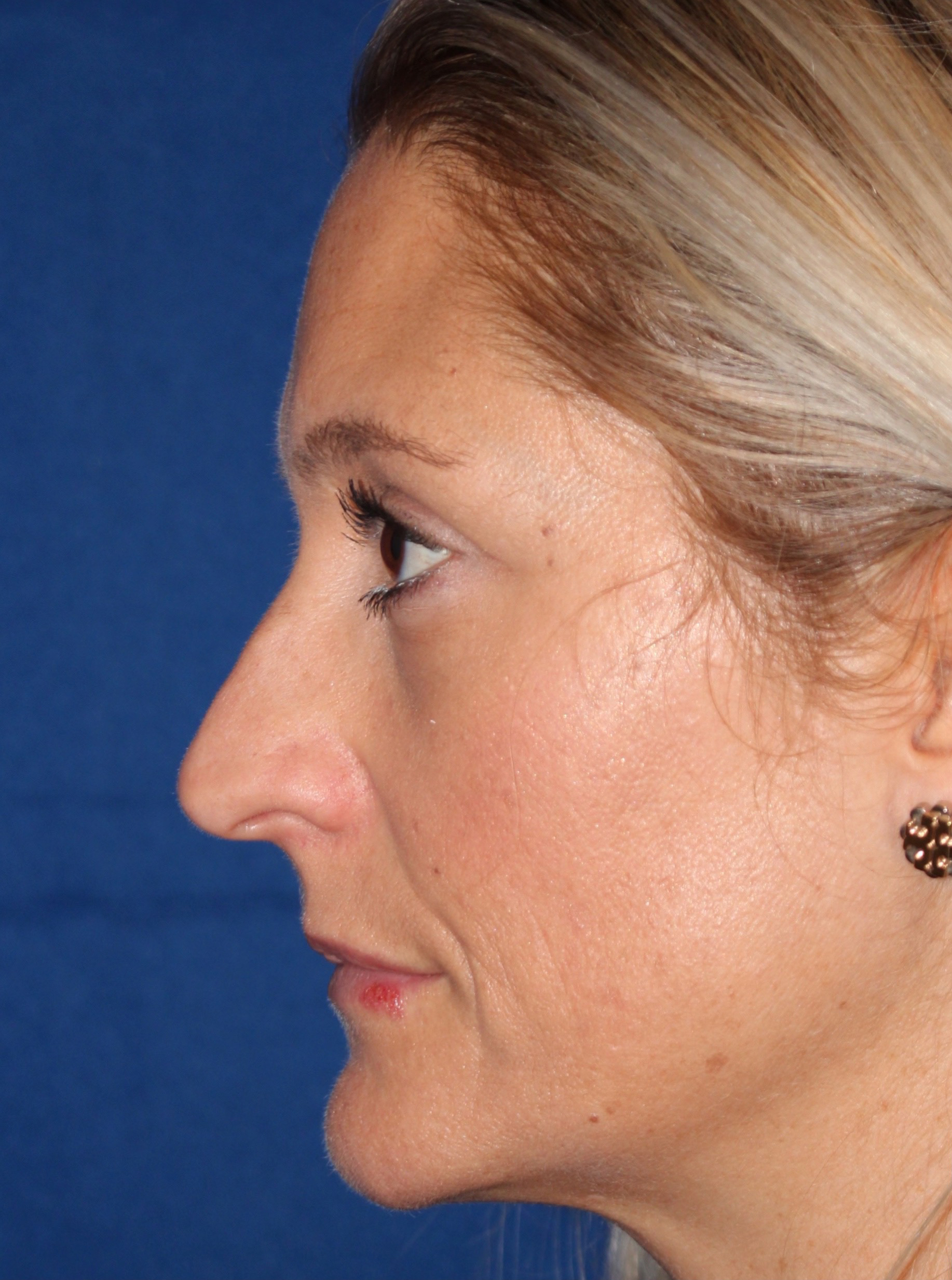 Female Cosmetic Rhinoplasty