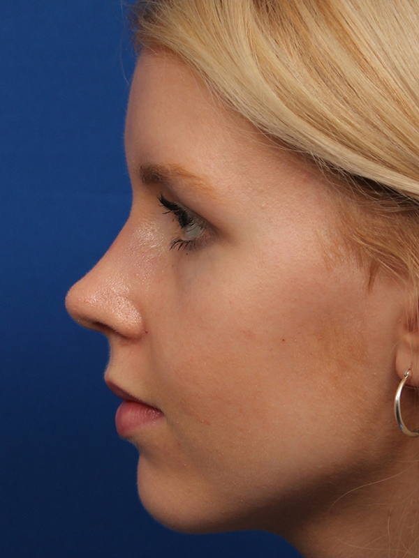 Female Cosmetic Rhinoplasty