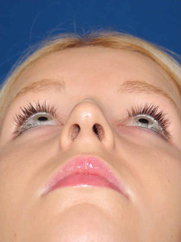 Female Cosmetic Rhinoplasty