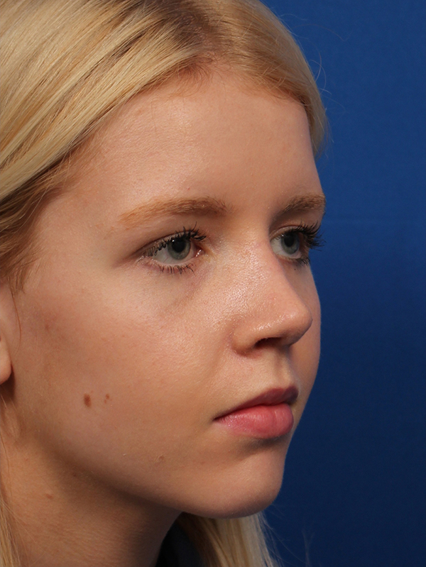 Female Cosmetic Rhinoplasty