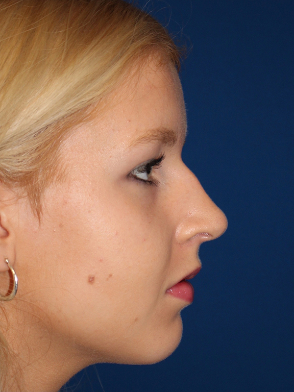 Female Cosmetic Rhinoplasty