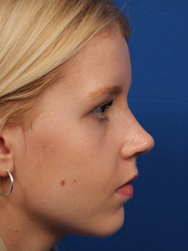 Female Cosmetic Rhinoplasty