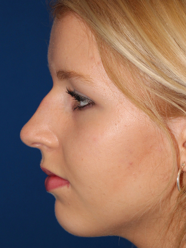 Female Cosmetic Rhinoplasty