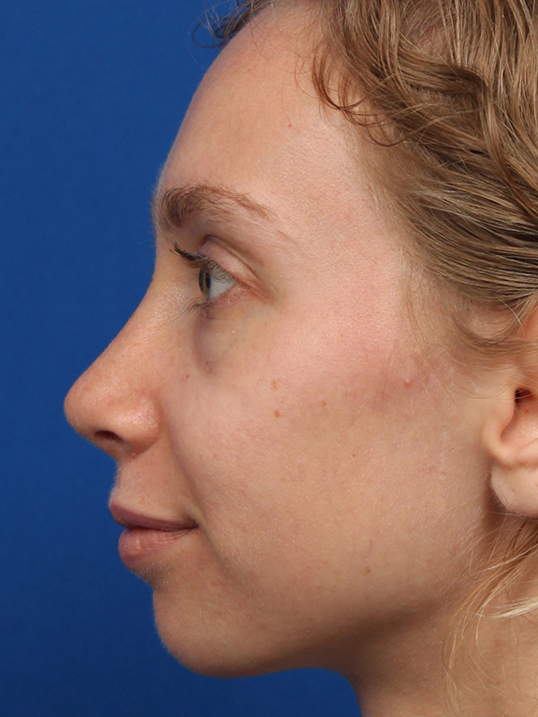 Female Cosmetic Rhinoplasty