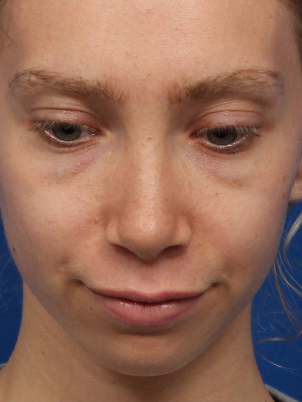 Female Cosmetic Rhinoplasty