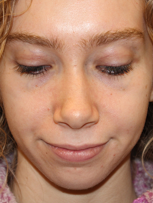 Female Cosmetic Rhinoplasty