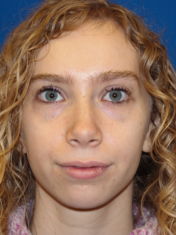 Female Cosmetic Rhinoplasty