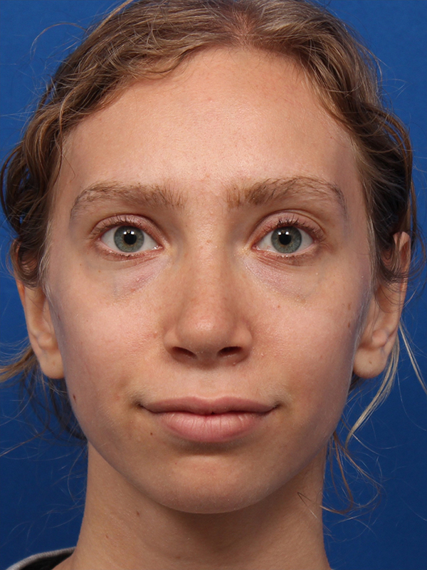 Female Cosmetic Rhinoplasty