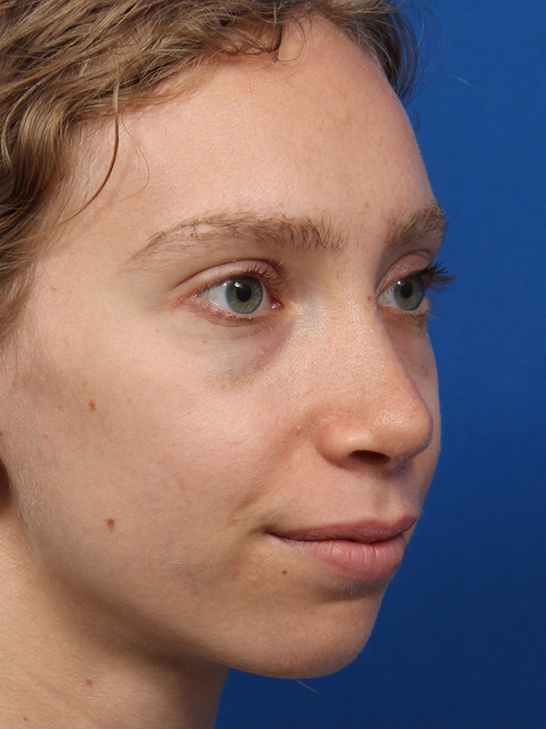 Female Cosmetic Rhinoplasty