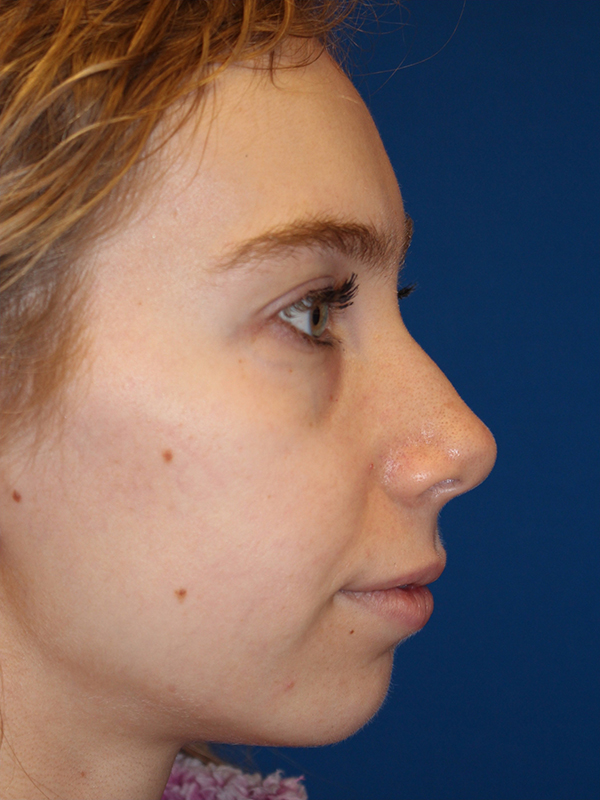 Female Cosmetic Rhinoplasty