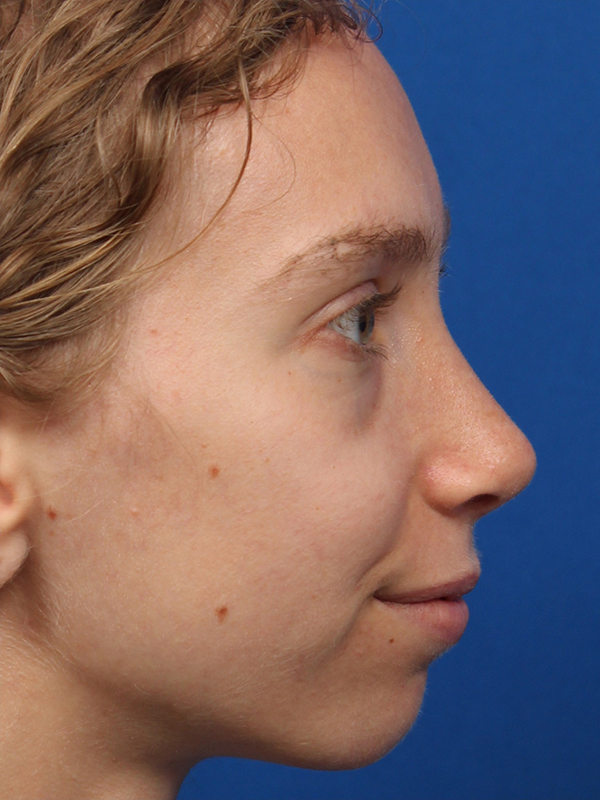 Female Cosmetic Rhinoplasty