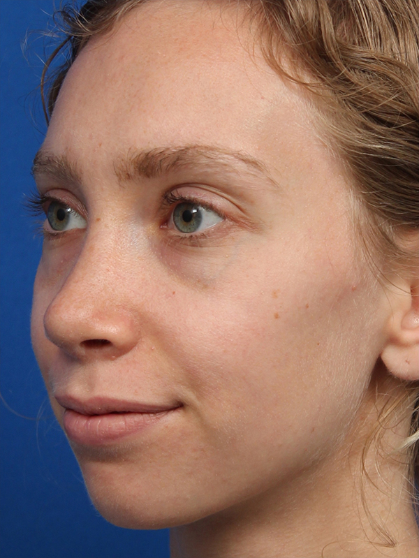 Female Cosmetic Rhinoplasty