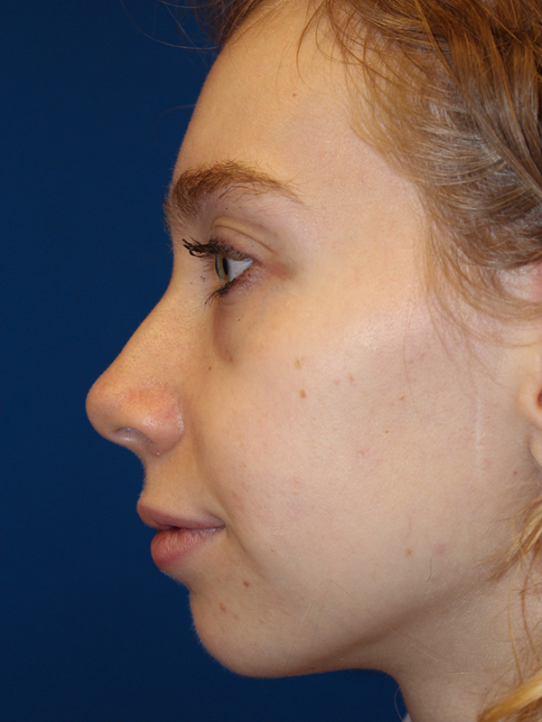 Female Cosmetic Rhinoplasty