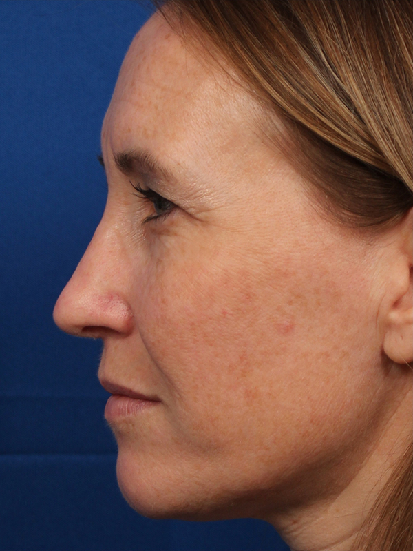 Female Cosmetic Rhinoplasty