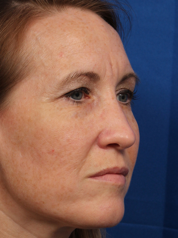 Female Cosmetic Rhinoplasty