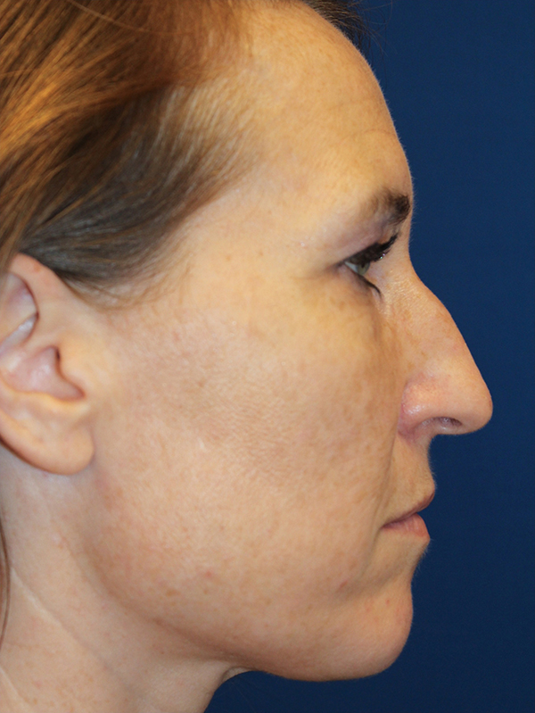 Female Cosmetic Rhinoplasty