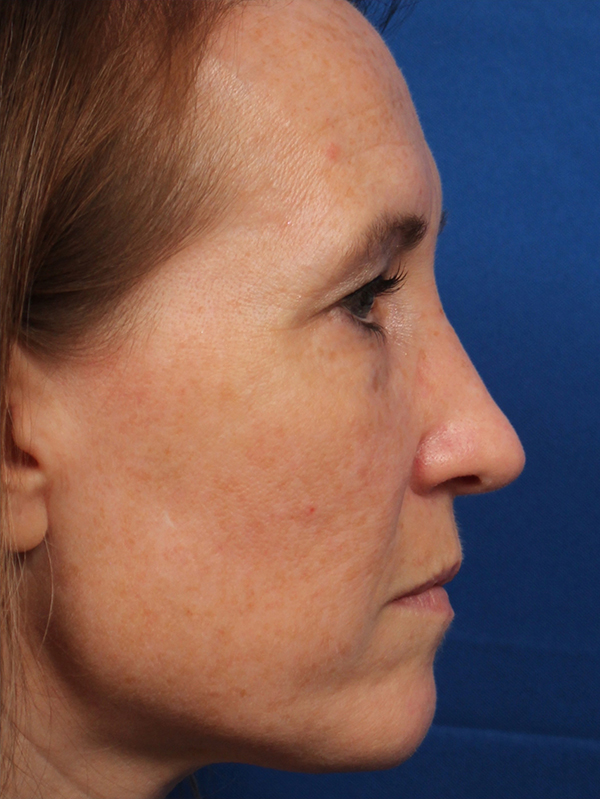 Female Cosmetic Rhinoplasty