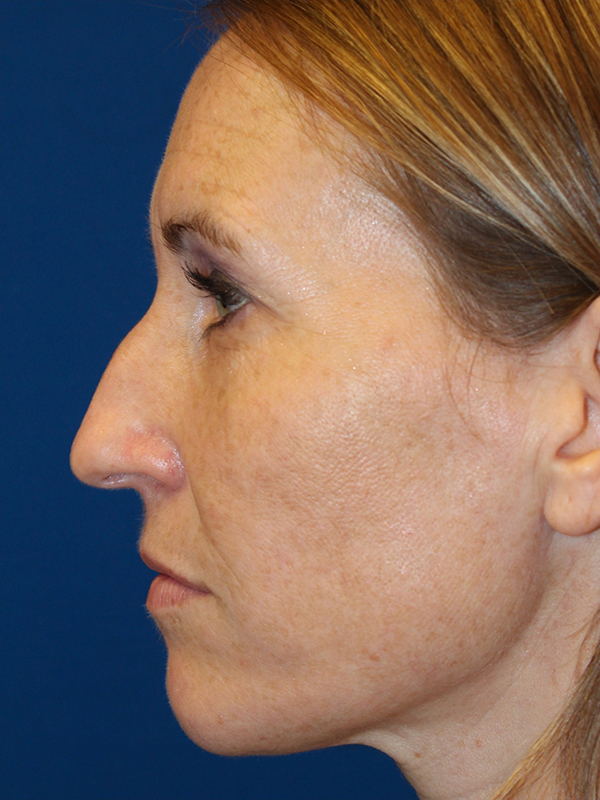 Female Cosmetic Rhinoplasty