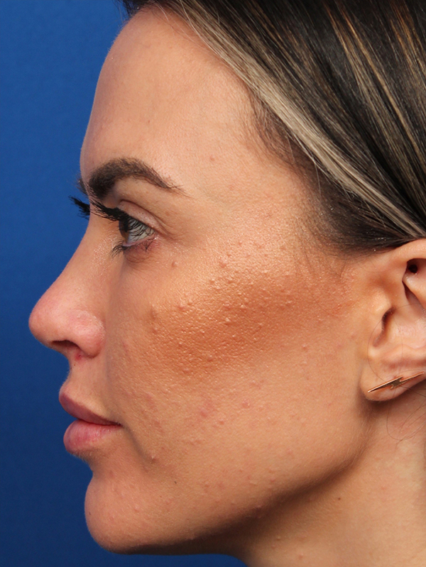 Female Revision Rhinoplasty