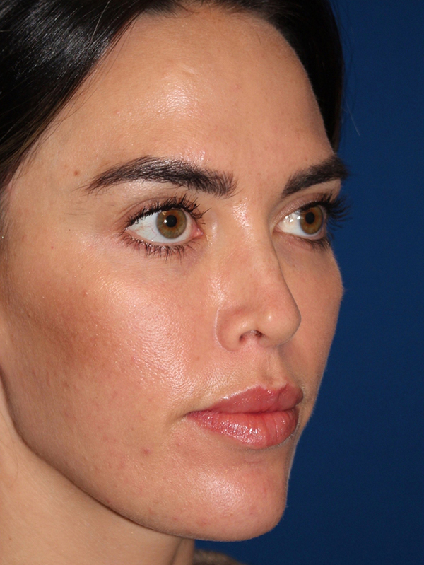 Female Revision Rhinoplasty