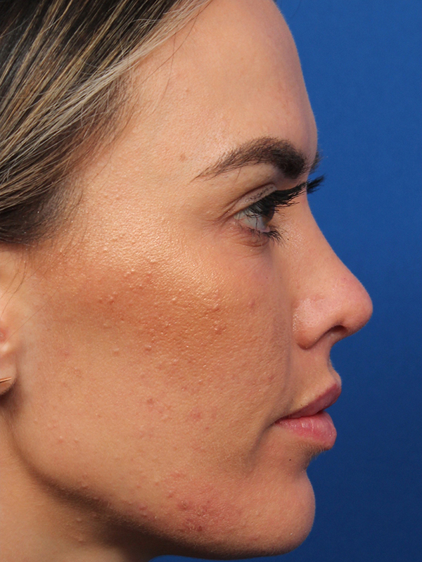 Female Revision Rhinoplasty