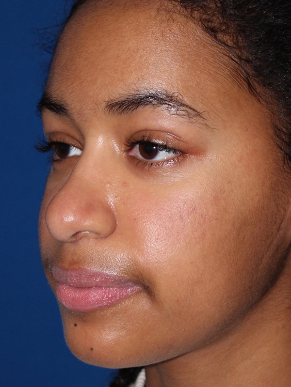 Female Revision Rhinoplasty