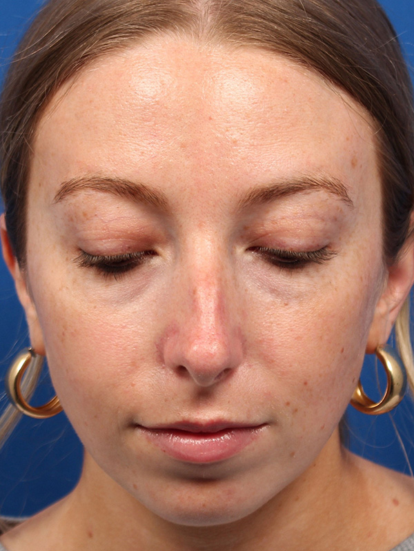 Female Cosmetic Rhinoplasty