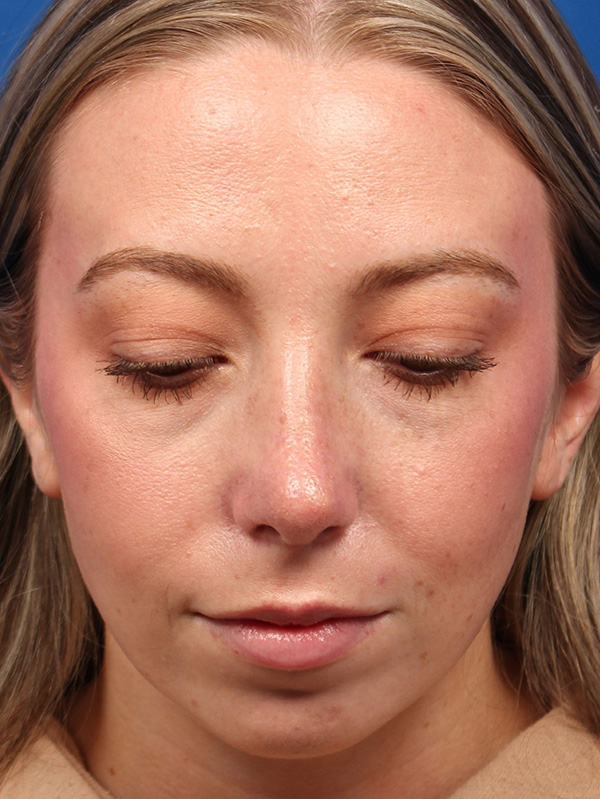Female Cosmetic Rhinoplasty