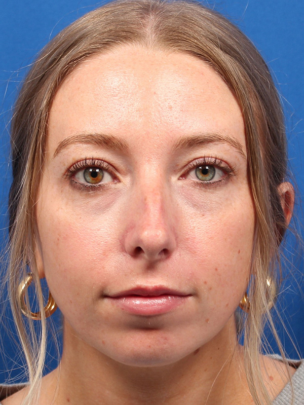 Female Cosmetic Rhinoplasty