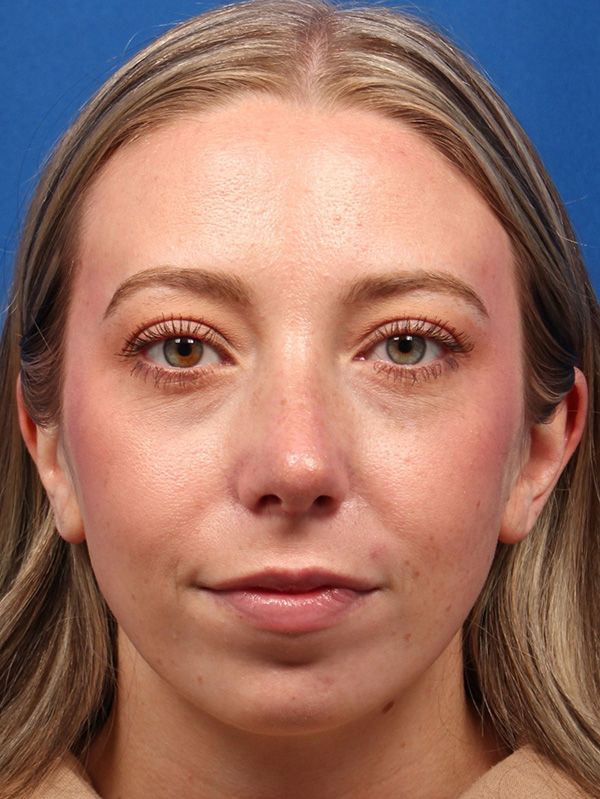 Female Cosmetic Rhinoplasty