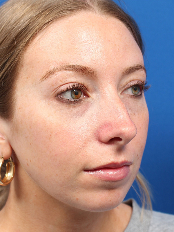 Female Cosmetic Rhinoplasty