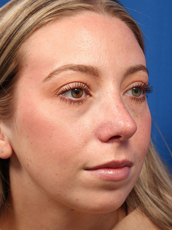 Female Cosmetic Rhinoplasty