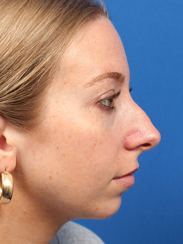 Female Cosmetic Rhinoplasty