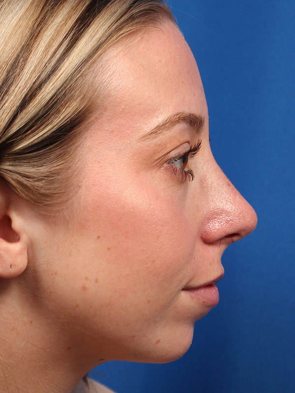 Female Cosmetic Rhinoplasty