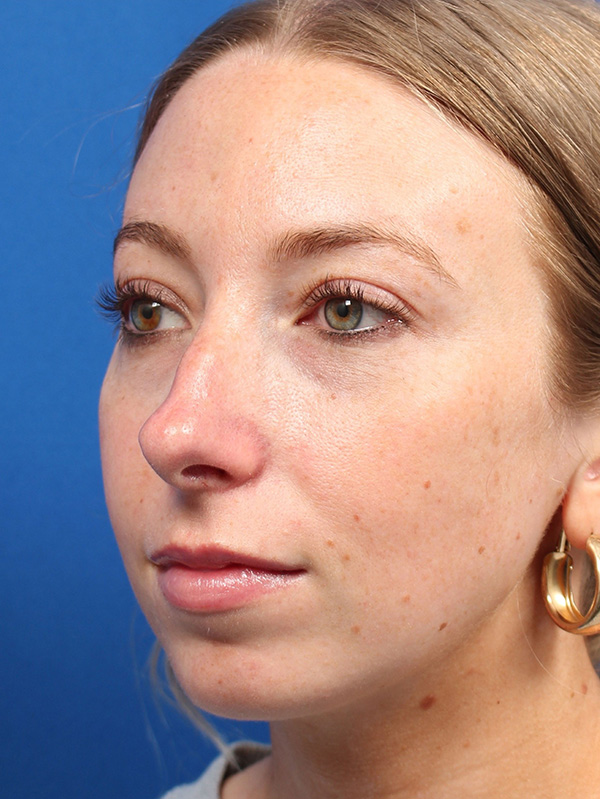 Female Cosmetic Rhinoplasty