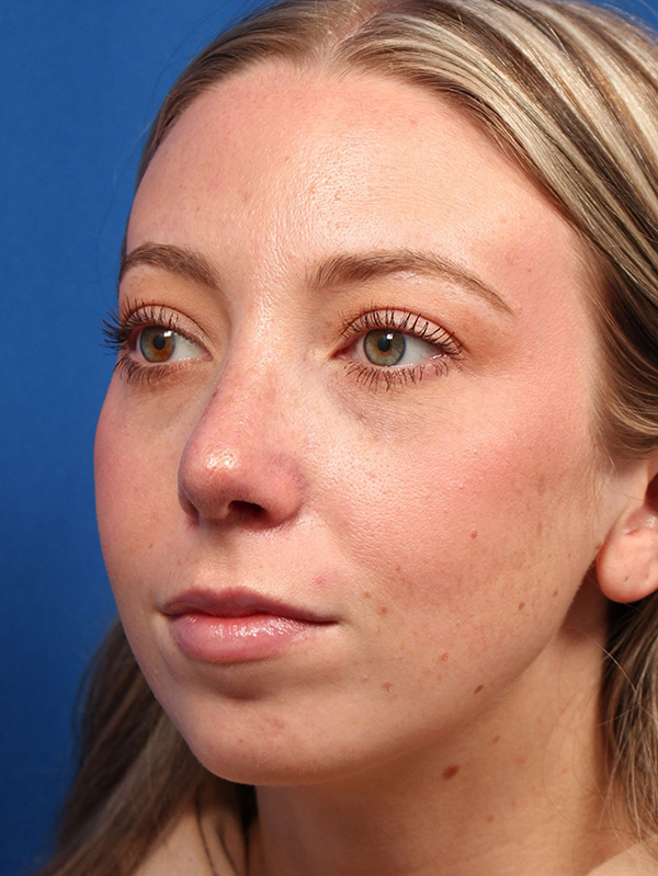 Female Cosmetic Rhinoplasty