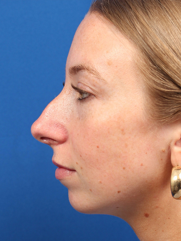 Female Cosmetic Rhinoplasty