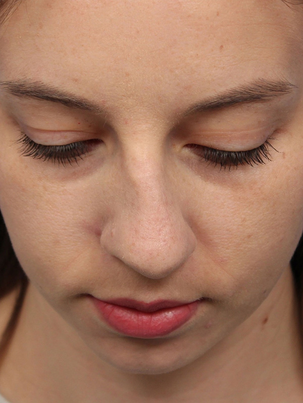 Female Cosmetic Rhinoplasty