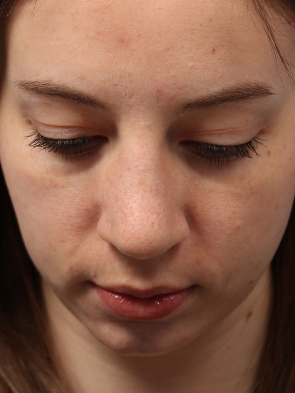 Female Cosmetic Rhinoplasty