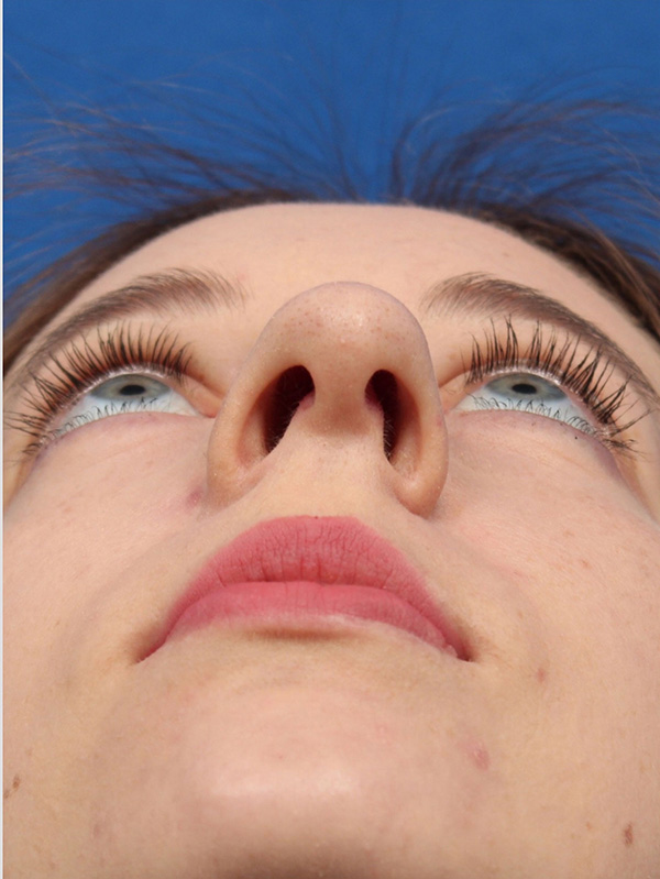 Female Cosmetic Rhinoplasty