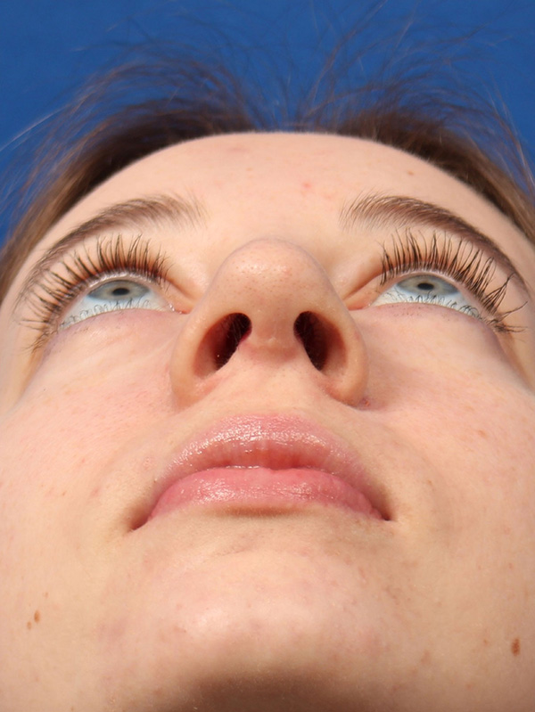 Female Cosmetic Rhinoplasty