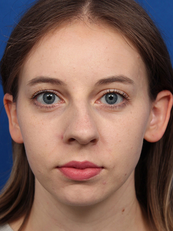 Female Cosmetic Rhinoplasty