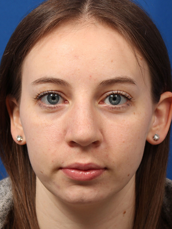 Female Cosmetic Rhinoplasty