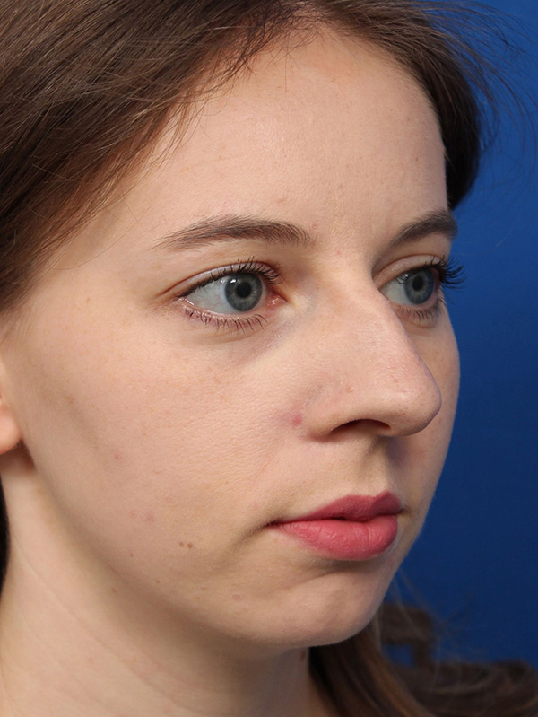 Female Cosmetic Rhinoplasty
