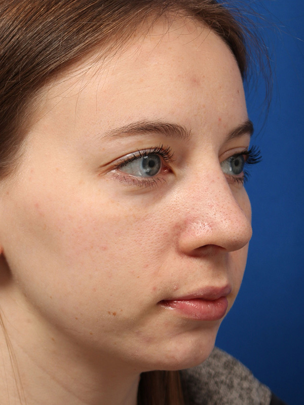 Female Cosmetic Rhinoplasty