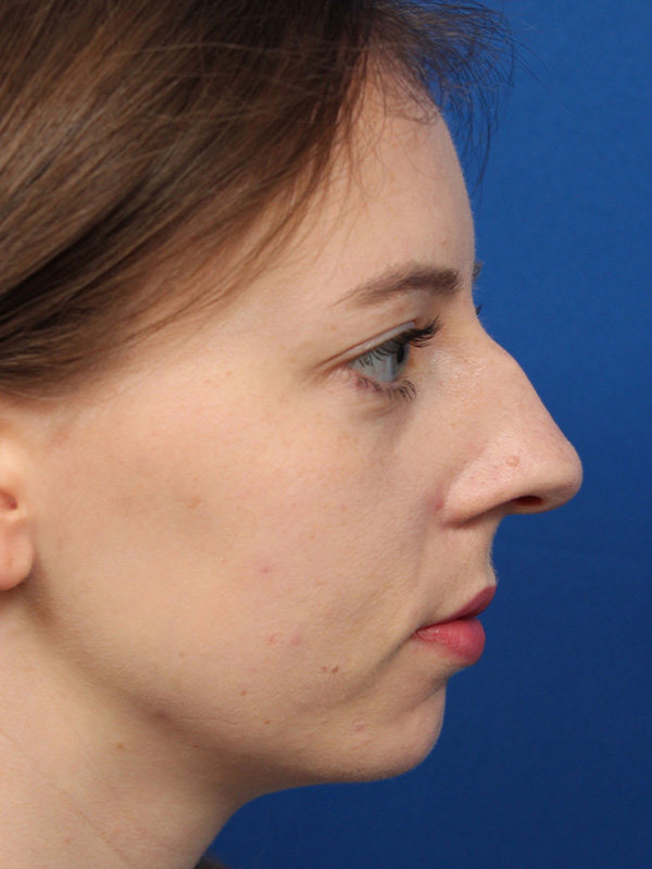 Female Cosmetic Rhinoplasty
