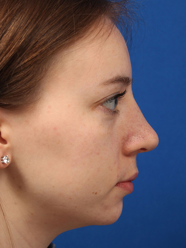 Female Cosmetic Rhinoplasty