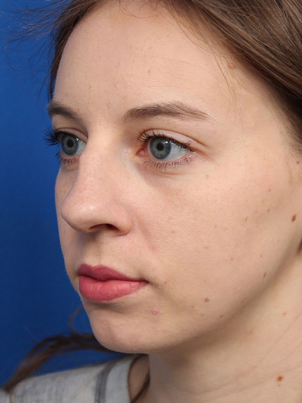 Female Cosmetic Rhinoplasty