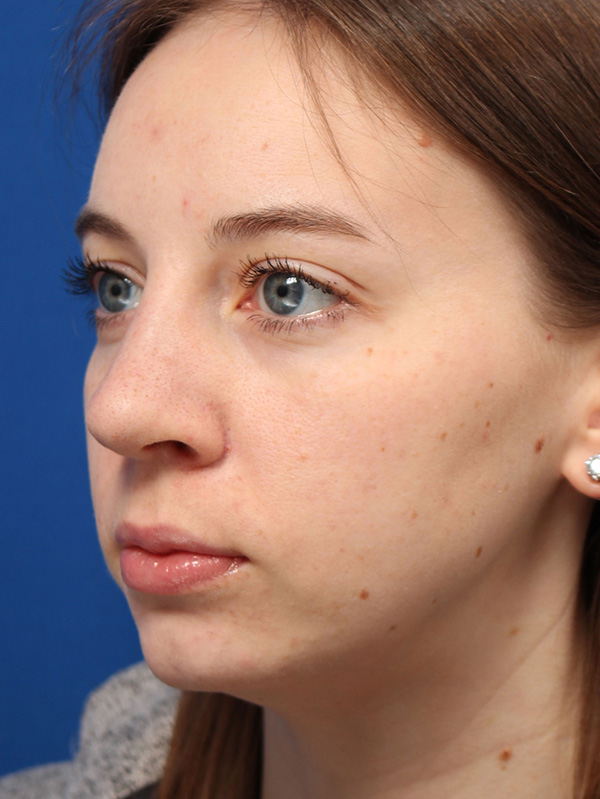 Female Cosmetic Rhinoplasty